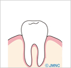 天然歯と1回法インプラント・2回法の比較